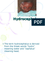 Hydrocephaluss