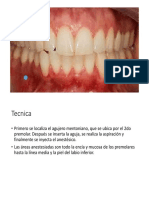 Anestesia Nervio Mentoniano