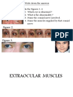 Extraocular Nerve Palsy