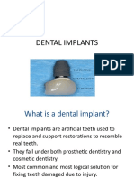 Dental Implants