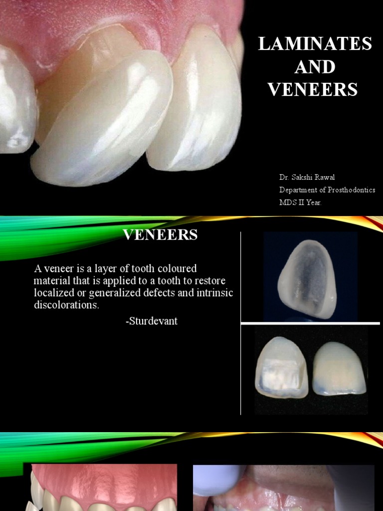 Laminates and Veneers | PDF | Tooth Enamel | Dental Composite