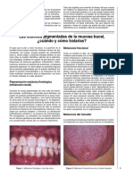 Las Lesiones Pigmentadas de La Mucosa Bucal. Cuándo y Cómo Tratarlas (Cut)