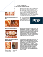 Enamel Hypoplasia