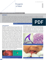 A Rare Case of Pyogenic Granuloma With A Natal Tooth: Abst T