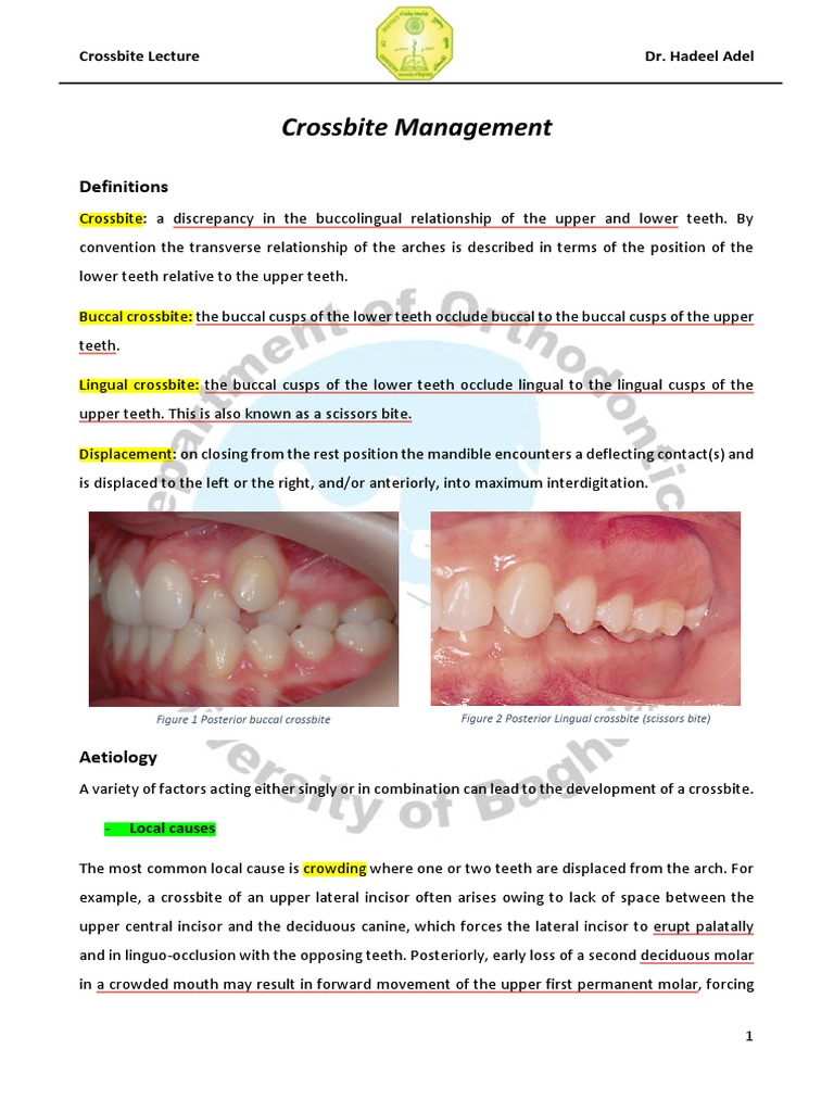 CrossBite Lecture Dr. Hadeel Adel | PDF | Dentistry Branches | Dental ...