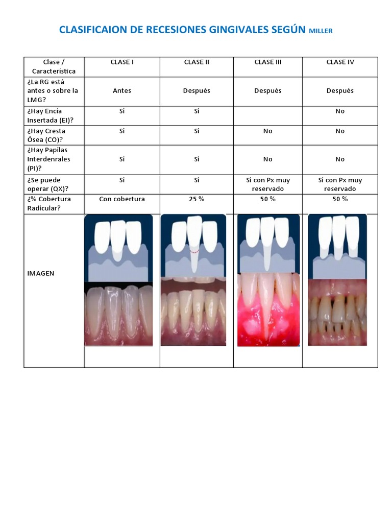 Clasificación de Recesiones Gingivales según Miller | PDF