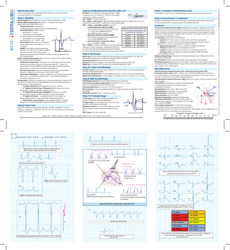 ECGpedia Reference Chart | PDF | Electrocardiography | Cardiac Arrhythmia