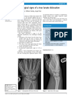 Radiological Signs of A True Lunate Dislocation: Adam Tucker, William Marley, Angel Ruiz