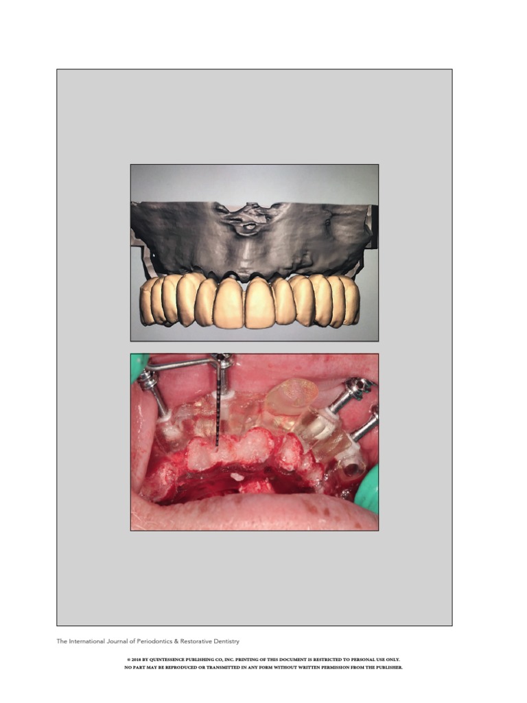 Scalloped Guide IJPRD PDF Dental Implant Prosthesis