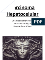 Carcinoma Hepatocelular