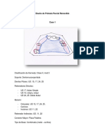 Diseño de Prótesis Parcial Removible - BRIYI RINCÓN