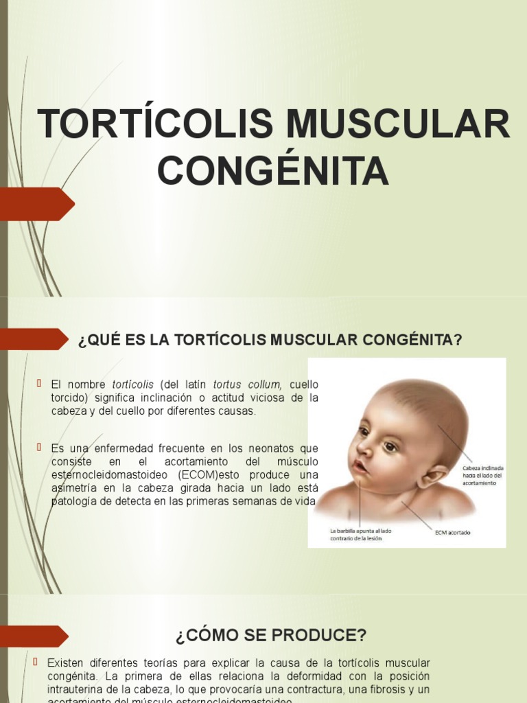 Tortícolis Congénita: Causas y Tratamiento | PDF | Enfermedades y