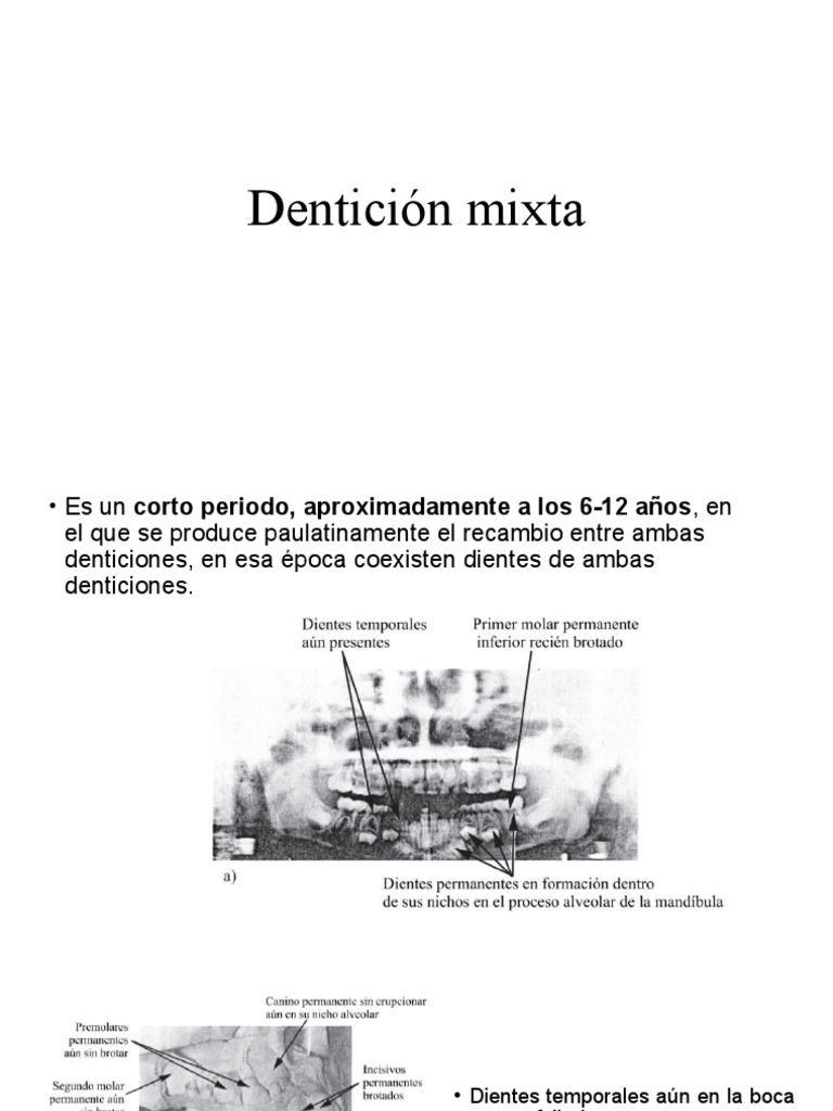 Dentición Mixta: Etapas y Desarrollo | PDF