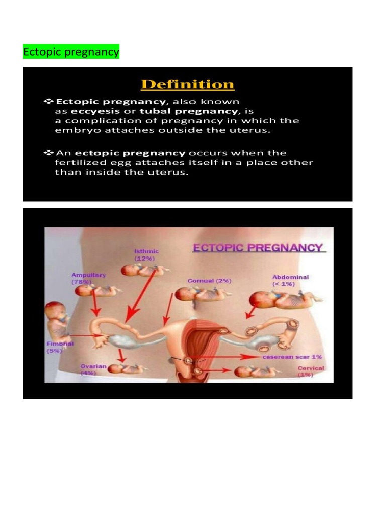 Ectopic Pregnancy PDF