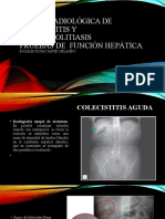 Sesion Radiológica de Colecistitis y Coledocolitiasis