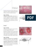 Pápula. Pústula. Figura 1-2A Pápula. Figura 1-2B Pápula. Figura 1-3A Pústula. Figura 1-3B Pústula. Papule. Pustule