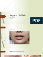 Angular Cheilitis