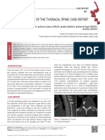Giant Cell Tumor of The Thoracal Spine Case Report 2020