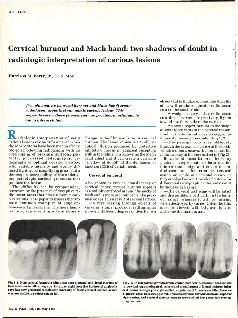 Cervical Burnout and Mach Band Two Shadows of Doubt in Radiologic