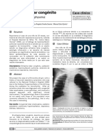 Enfisema Lobar