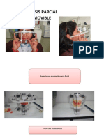 Protesis parcial removible: montaje de modelos