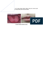 Pasien Wanita Umur 34 TH Datang Dengan Keluhan Bibirnya Kering Dan Sariawan Pada Lidahnya Sejak 3 Hari Yll. Kadang Kadang Sakit. BLM Pernah Diobati