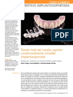 1 Puente Total Del Maxilar Superior Condicionalmente Extraíble