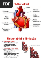 Flutter Atrial