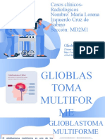 Caso Clinico Glioblastoma Multiforme