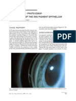 Clinical Case - Photo Essay Primary Cyst of The Iris Pigment Epithelium