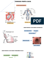 Anastomosis Venosa Cava