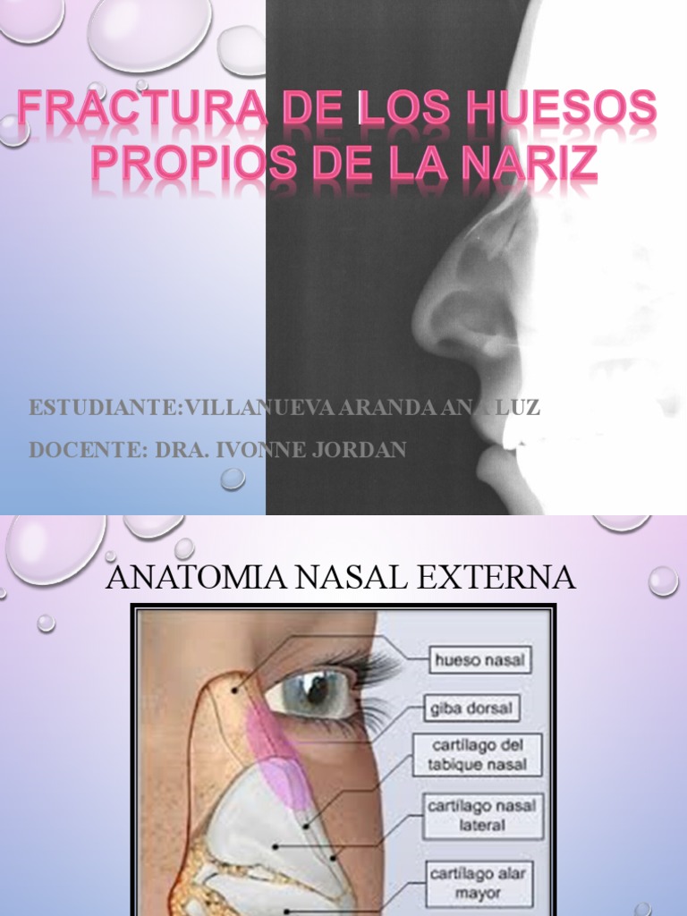Fractura-De Los-Huesos-Propios de La Nariz | PDF | Hueso | Anatomía