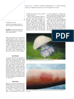 Rhizostoma Pulmo: Irritant Contact Dermatitis From The Jellyfish