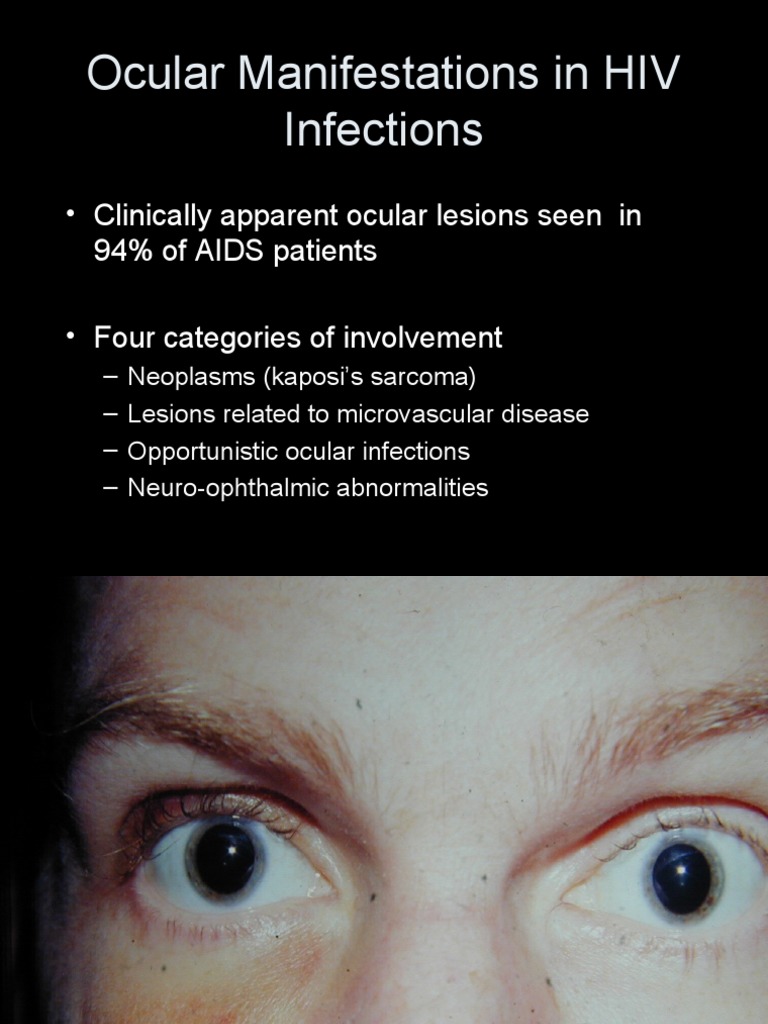 Ocular Manifestations in HIV Infections | PDF | Epidemiology | Medicine