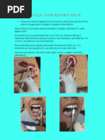 Técnicas de Anestesia Mandibular | PDF | Diente | Boca