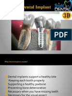 3D Printed Dental Implant