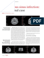 A Cavernous Sinus Infection A Root Canal Case