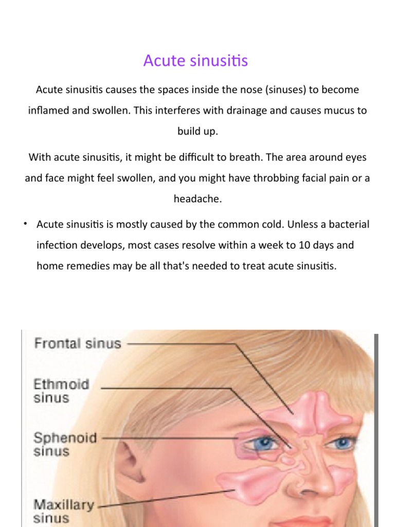 Acute Sinusitis: Causes, Symptoms, Diagnosis, Prevention And Treatment ...