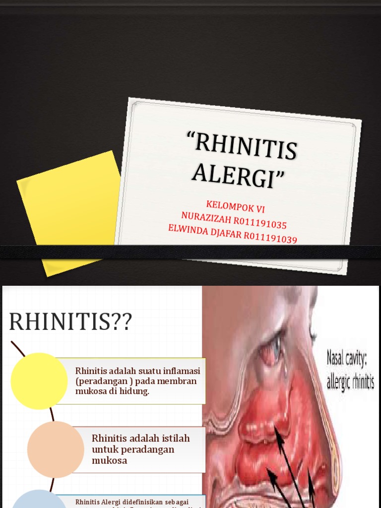 Kelompok Vi PPT Rhinitis Alergi Nurazizah Kmb2 | PDF