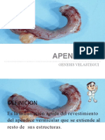 Apendicitis 