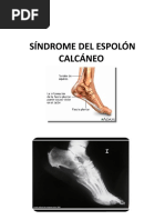 Proceso de Stieda y su tratamiento | PDF | Tobillo | Cirugía