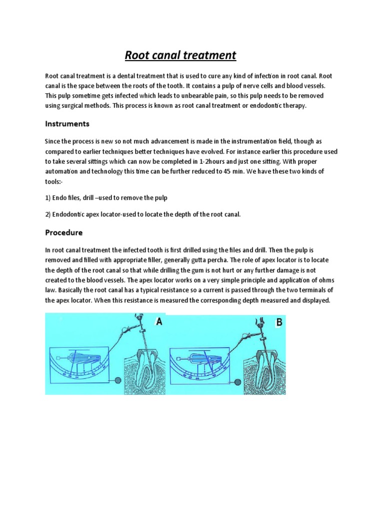 Root Canal Treatment Overview | PDF