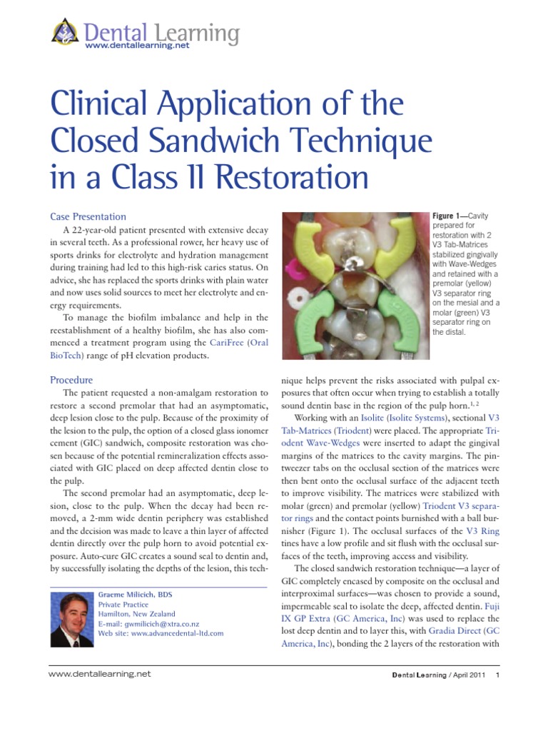 Clinical Application of The Closed Sandwich Technique in A Class II Restoration PDF Tooth