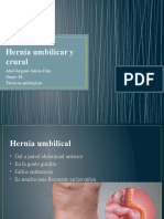 Hernia Umbilicar y Crural