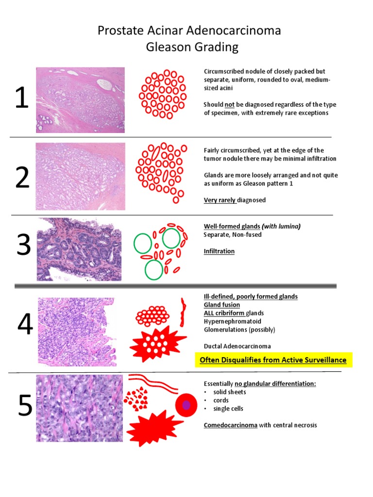 Gleason Grading in Prostate Adenocarcinoma | PDF | Pathology | Causes ...