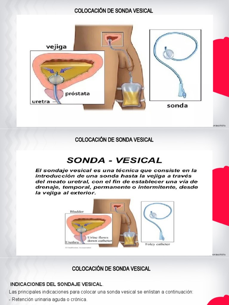 Sonda Urinária Masculina _ Guia de Cateterismo Vesical Masculino – AQEIIJ