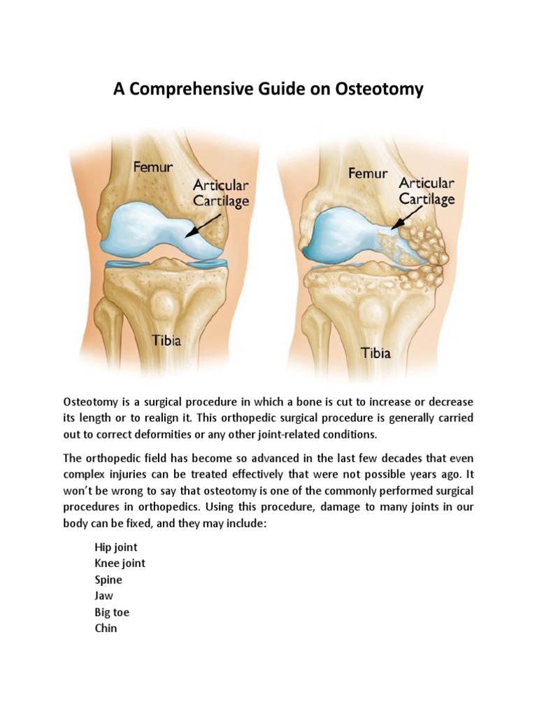 Osteotomy: Procedure and Recovery Guide | PDF | Orthopedic Surgery ...