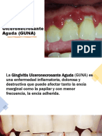 Gingivitis Ulceronecrosante Aguda.