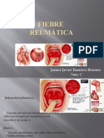   Fiebre Reumática