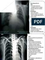 Foto Thorax PA (1) Cor